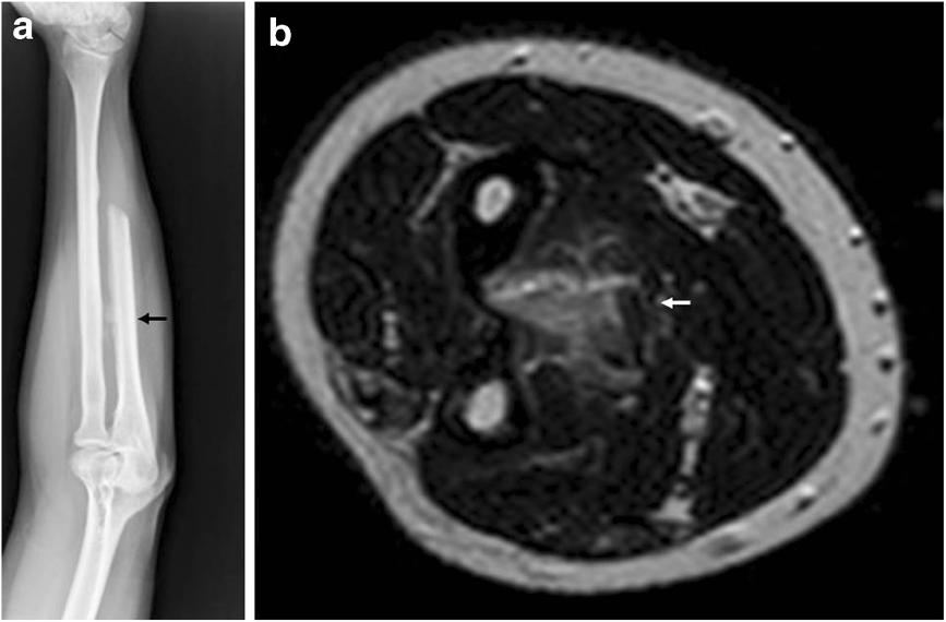 Spinelli et al. World Journal of Surgical Oncology 2012, 10:260 Page 3 of 5 Figure 4 After 18 months X-rays showed small ossifying mass in the interosseus membrane.