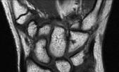 2010; 35(5):807-812 Other Imaging Modalities MRI: Vickers ligament can be visible on MRI Role of MRI in diagnosis is