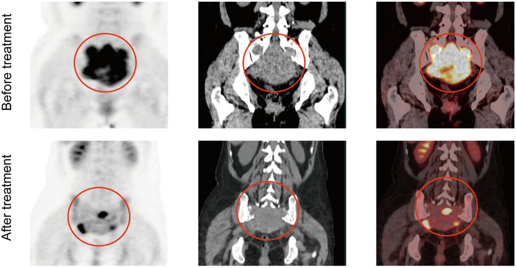 Effects of denosumab on sacral GCT 457 Figure 5.