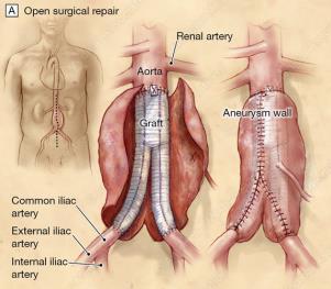 Aortic Repair Surgical open and