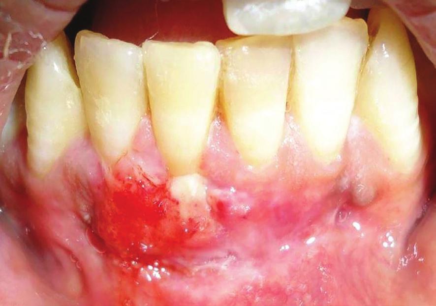 (v) Width of attached gingiva (WAG) was measured as the distance between the mucogingival junction and the projection on the external gingival surface of the most apical portion of the gingival