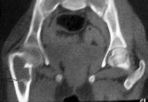 The patient was subsequently taken up for surgery and Watson Jones approach [5] was used to approach the hip and intralesional extended curettage was performed.