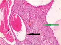 4: Histopathological image of aneurysmal bone cyst (black arrow, red lines and green arrow) reveal blood filled sinus, multinucleate giant cells and fibrous tissue respectively.