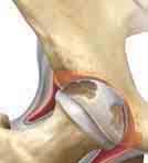 During surgery, your damaged hip joint will be replaced with an artificial joint (prosthesis).