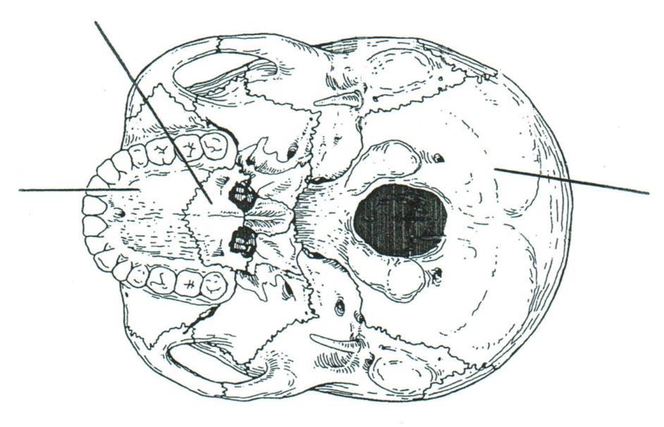 3. The figure below is an inferior view of the head (with mandible removed).