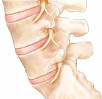 What is Spondylolisthesis? Spondylolisthesis is a condition in which one of the vertebrae slips forward or backward.