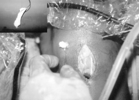 RESECTION WITH HELP OF SUTURE PUNCH 667 In the case of reduction of the bucket-handle tear to its original position, the anterior portion of the buckethandle fragment is probed first to test the