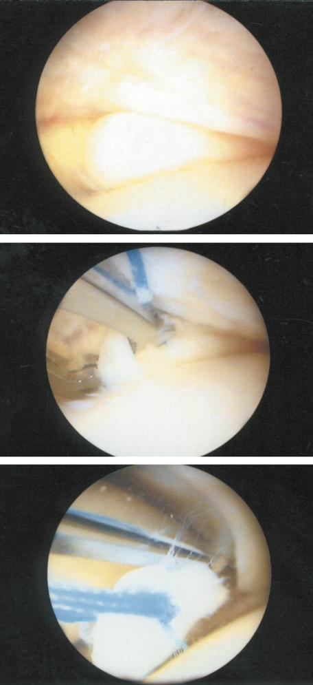 The bucket-handle fragment is removed from the joint through the same portal with the hand-held sutures in a standard fashion. of losing the fragment within the joint.