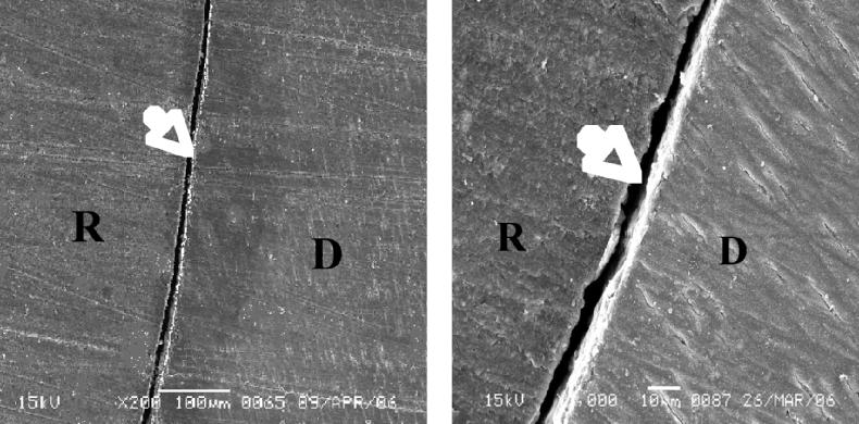 D= Dentin, R= Restoration; arrow indicates gap. Figure 2. Low and high magnification SEM image (200x and 1000x) of the microleakage pattern shown at the interface between Admira Flow and dentin.