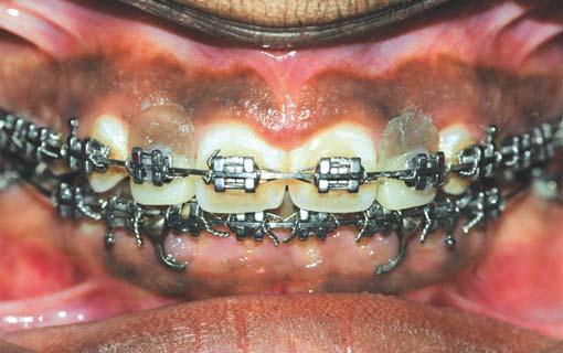 She had an horizontal overjet of 4 mm,vertical overbite of 2 mm and generalized spacing in maxilla.