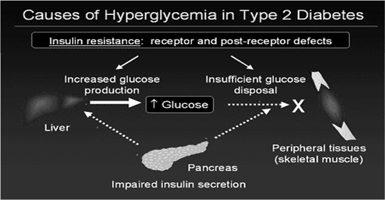 DUAL IMPAIRMENT IN T2 DIABETES 1.Impaired insulin action (insulin resistance) 2.