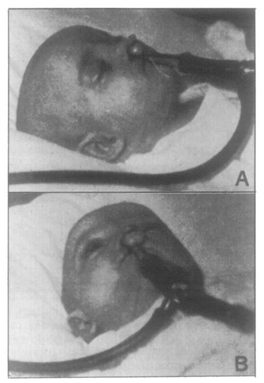 consider : (r) repair of the lip; (2) the formation of the nasal tip and nasal airways; (3) the correct alignment of the alveolus. First it is essential to consider the deformity.