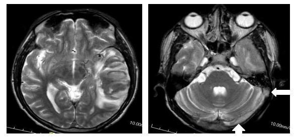 Figure 2: T2W axial images of same patient showing hematoma in left temporal lobe which is predominantly hypointense with