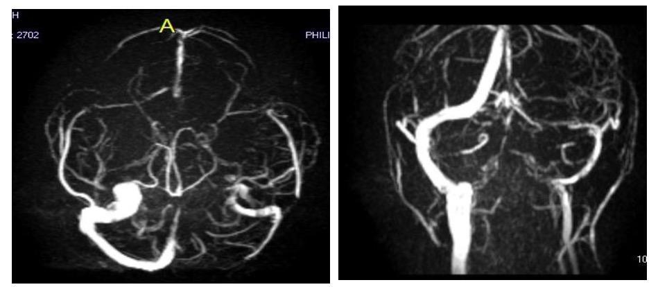 Figure 5: MR angiography reformatted images showing left transverse sinus thrombosis Case2:Reversible Cerebral Vasoconstriction Syndrome 35 years old female, one week post normal delivery presented