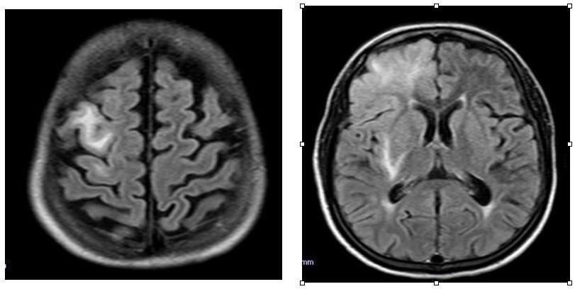 DWI images revealed gyriform pattern hyperintensity in right frontal lobe with signal drop on ADC suggestive of restricted diffusion (Figure 8).