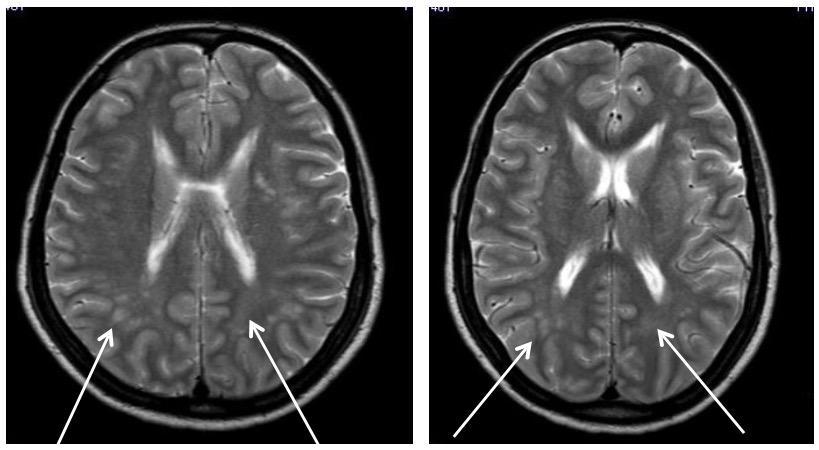 Case 3: Posterior Reversible Encephalopathy Syndrome. A 31 years old female presented with severe occipital headache, nausea, vomiting and two episodes of seizure and photophobia.