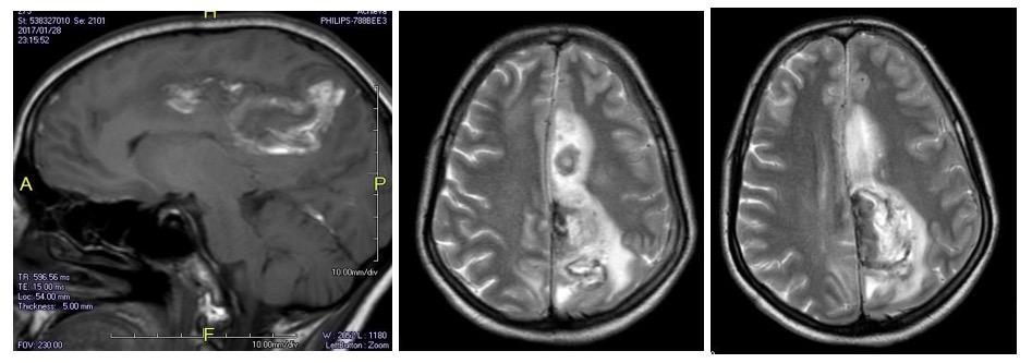 Figure 15 : T2W axial images reveals hematoma in left parietal lobe