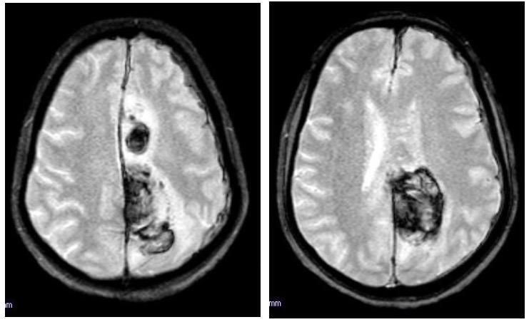 Figure 16: T2 FLAIR images of same patient showing hematoma.