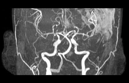 Figure 18: MR Angiography reformatted coronal image is unremarkable. Discussion Acute neurological conditions in post partum period are usually related to eclampsia.