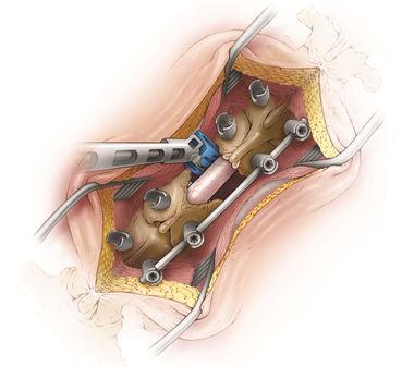Mini-open Technique Open transpedicular corpectomy: traditional exposure