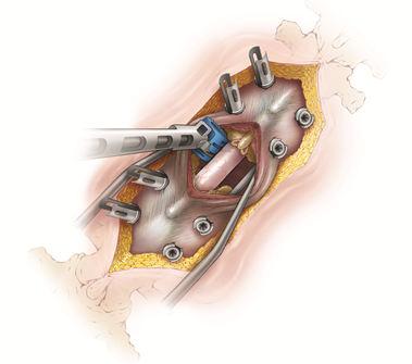 transpedicular corpectomy: midline facial dissection only over the