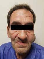 Odontogenic keratocyst of mandibular condylar region / 86 Case Report The patient was a 49-year-old man who referred to the Maxillofacial Surgery Clinics of Shariati Hospital complaining of left