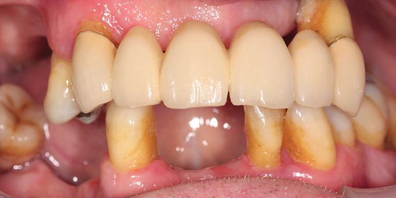 Case Study 1: Implants Following consultation, this patient s ambitions and hopes centred on improving his enjoyment of food and replacing a very uncomfortable denture.