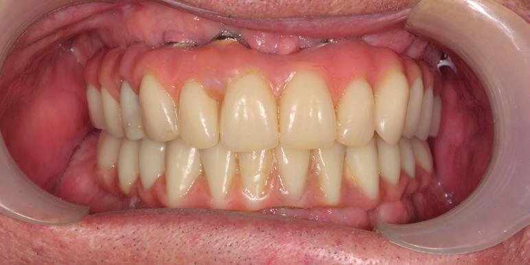 IMPLANT DENTISTRY We offer solutions for single tooth replacement to full mouth rehabilitation with dental implants.