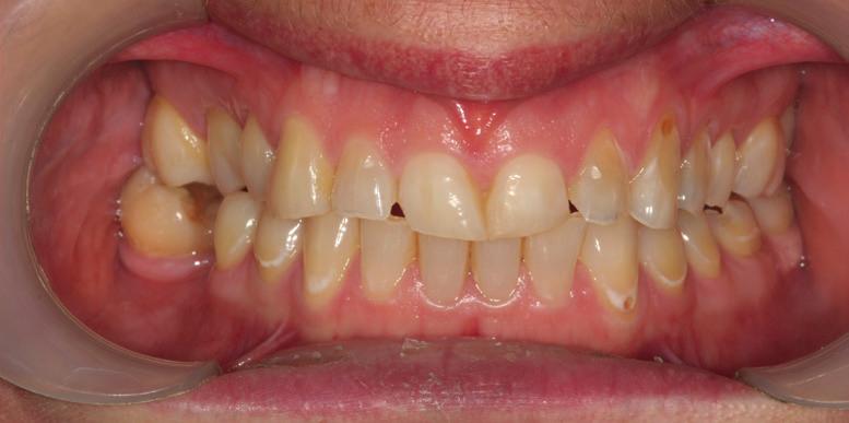 Treatment included a full mouth rehabilitation with alteration of vertical dimension.