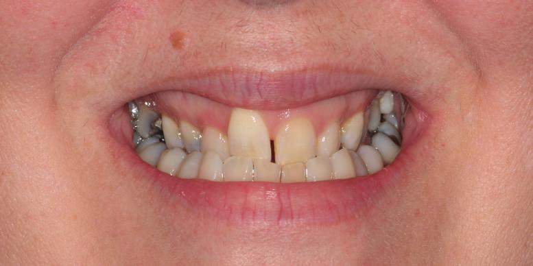 Ideally, the patient required orthodontic treatment, followed by maxillary osteotomy.