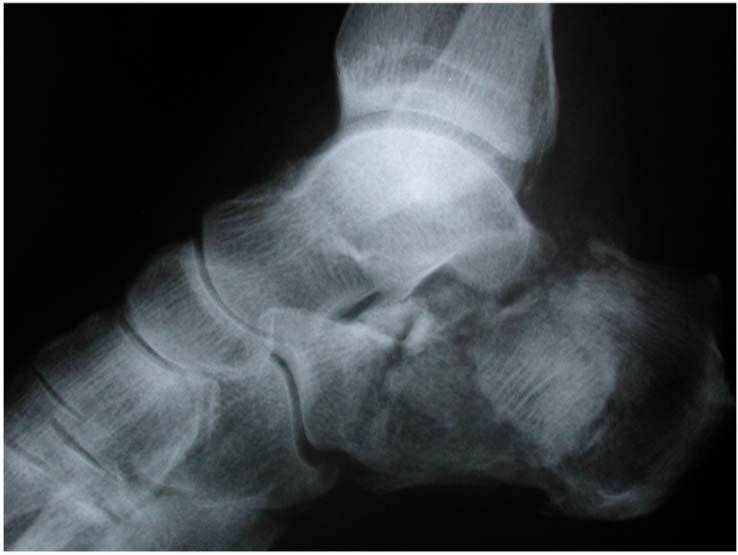 Staged Subtalar Fusion for Severe Calcaneus Fractures with Bone Loss The Open Orthopaedics Journal, 2013, Volume 7 615 staged approach.
