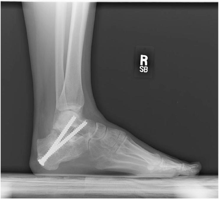 616 The Open Orthopaedics Journal, 2013, Volume 7 Williams et al. Fig. (2). Coronal CT demonstrating medial extrusion of posterior calcaneal facet.