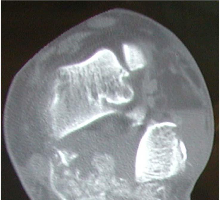 RESULTS We treated 6 calcaneus fractures with bone loss. Four fractures were open and two were closed.