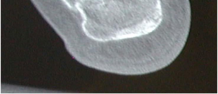 Of the 6 patients, 4 sustained additional injuries. Fig. (4). Lateral radiograph demonstrating subtalar fusion. All patients were treated with staged subtalar fusion.