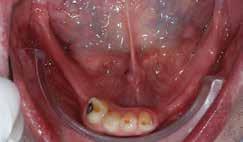 I m trying to help this man and as you can see he s got a deep bite and no occluding posterior teeth.