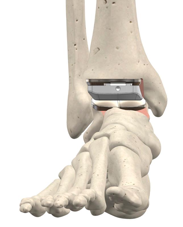 The Cadence ankle replacement has an anatomic shaped articulating surface, and allows for natural motions of the deltoid and lateral ligaments.