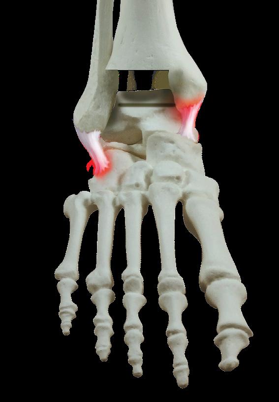 Cylindrical Articulating Geometry Cadence Ankle Anatomical Articulating Surface The Cadence Total Ankle System is designed to restore the natural ankle motion of the ankle by recreating the conical