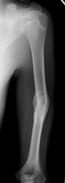 HUMERAL SHAFT FRACTURES Almost all patients have some minor deformity