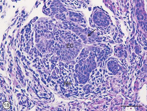 SUPPLEMENTARY FIG. S18. Teratocarcinoma. Nests of EC undergoing differentiation into embryonic mesenchyme (Me), and possibly into a NT (arrow).