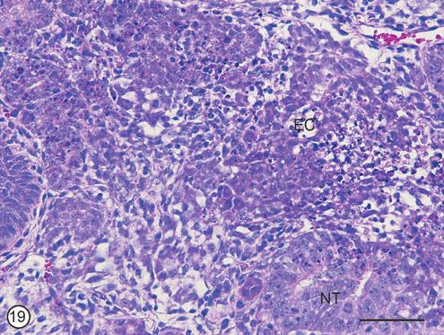 SUPPLEMENTARY FIG. S19. Teratocarcinoma. EC cells form a nest surrounded by mesenchymal cells, which are more loosely textured.