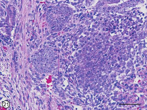 SUPPLEMENTARY FIG. S21. Teratocarcinoma.