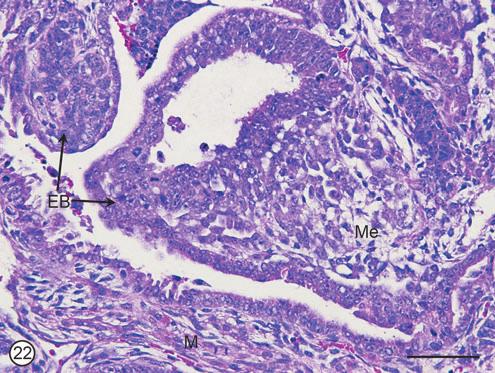 SUPPLEMENTARY FIG. S22. Teratocarcinoma. Two embryoid bodies (EBs) protrude into a cavity.