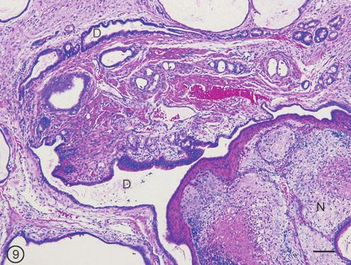 SUPPLEMENTARY FIG. S9. Teratoma. The tumor contains several elongated ducts (D) lined by cuboidal or columnar epithelium.