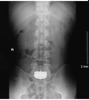 ISO 9001:2015 FS 550968 What is Lumbar Disc Replacement? The intervertebral discs are the shock absorbers between the bones of the spine.