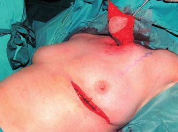 6 Plastic and Reconstructive Surgery Fig. 6.13 Coverage of the defect with an ipsilateral pectoralis major island flap. The skin island is raised from the fold under the breast.