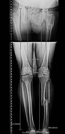 Malunion: Radiographic Evaluation Objective radiographic analysis answers the following questions: 1) Is there a? 2) Where is the? 3) What are the characteristics of the?