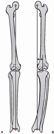 How to Determine Frontal Plane Alignment Steps to Identify & characterize 1. Obtain X-rays 2. Analyze limb alignment 3. Evaluate joint orientation 4. Find apex (aka CORA) 5. Identify type 6.