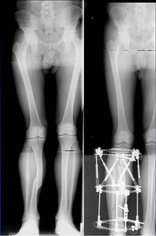Identify Apex Of The Deformity CORA (center of rotation and angulation) Steps to Identify & characterize 1. Obtain X-rays 2. Analyze limb alignment 3. Evaluate joint orientation sagittal plane 4.