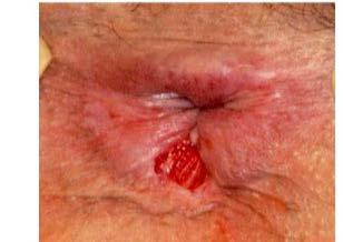 Next step? Colonoscopy with intubation of the TI Should you excise the skin tags?