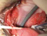 STOMATITIS This term is used for wide spread inflammation of the mucous lining of the structures of the mouth.